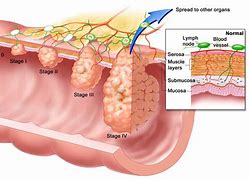 Image result for Esophageal Carcinoma