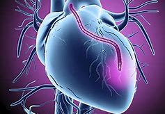 Image result for After Heart Bypass Surgery