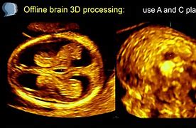 Image result for Fetal Brain Ultrasound