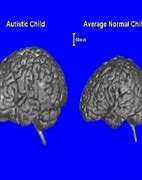 Image result for Autism Brain vs Normal