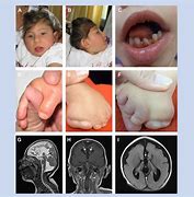 Image result for Congenital Microcephaly