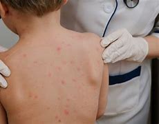 Image result for Mild Case of Chickenpox