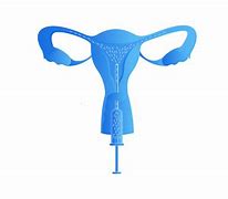 Image result for Artificial insemination