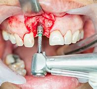 Image result for Dental Implant Bone Grafting Procedure