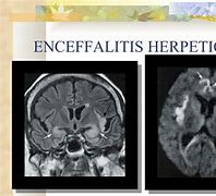 Image result for encefslomielitis