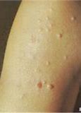 Image result for Molluscum Back Hand