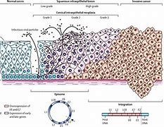 Image result for HPV Virus and Cervical Cancer