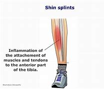 Image result for Shin Splint Lump
