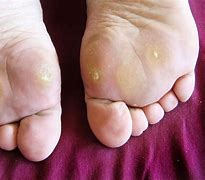 Image result for Seed Wart Foot