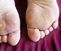 Image result for Planters Wart On Heel
