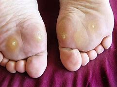 Image result for Different Types of Foot Warts