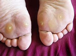 Image result for Infected Wart Bottom of Foot