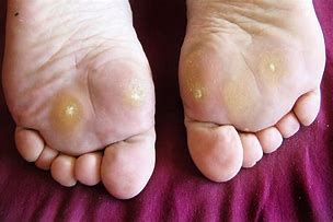 Image result for Warts On Feet