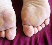 Image result for Plantar Warts On Soles of Feet