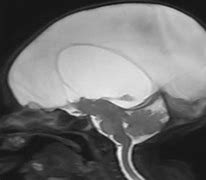 Image result for Hydranencephaly Assymptomatic