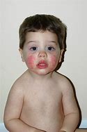 Image result for Fifth Disease in Young Children