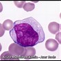 Image result for AML Leukemia