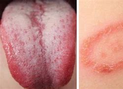 Image result for Thrush or Candidiasis