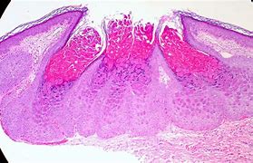 Image result for Molluscum Contagiosum Virus in Ethiopia