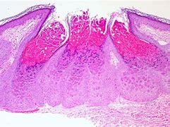Image result for Molluscum Bumps