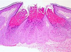 Image result for Molluscum Lesions