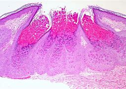 Image result for Molluscum Dermoscopy