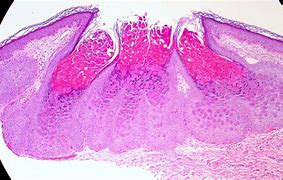 Image result for Molluscum Contagiosum Virus Lacks