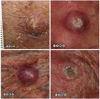 Image result for Cancerous Skin Nodules