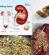 Image result for Male Kidney Stones
