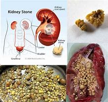 Image result for When Does a Kidney Stone Look Like