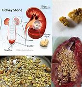 Image result for Small Kidney Stones