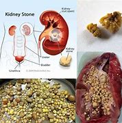 Image result for 6 Millimeter Kidney Stone