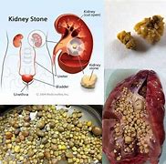 Image result for 1.4 Cm Kidney Stone