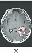 Image result for Types of Meningioma Brain Tumors
