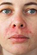 Image result for Rash around Mouth and Chin