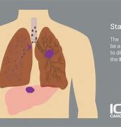 Image result for Stage 4 Lung Cancer