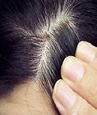 Image result for Dandruff Scabs On Scalp