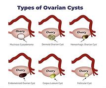 Image result for Types of Ovarian Masses