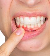 Image result for Thin Gums