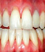 Image result for Gingival Recession