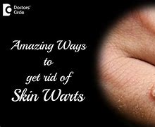 Image result for Dead Wart Removal