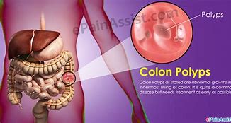 Image result for Colon Polyps Size