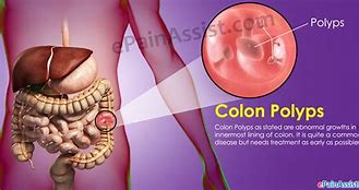 Image result for Colon Polyp Classification