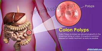 Image result for Burning Polyps in Colon