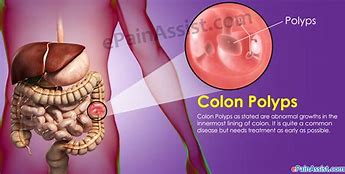 Image result for Colon Polyps Anatomy