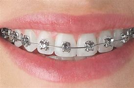 Image result for Silver Braces