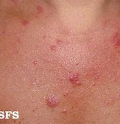 Image result for Skin Eruptions