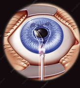Image result for Intraocular Lenses