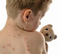 Image result for Measles