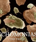 Image result for Discharge From Trichomoniasis